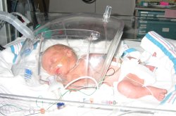 Adelaide in NICU